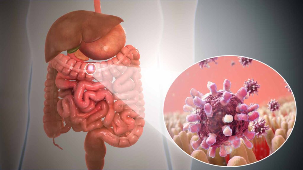 Food borne bacterial gastroenteritis caused by Salmonella, E. coli and Vibrio spp