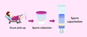 In vitro fertilization (IVF)