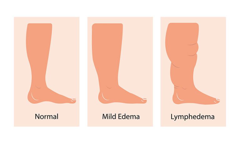 Brugia malayi: Introduction, Morphology, Pathogenesis,...