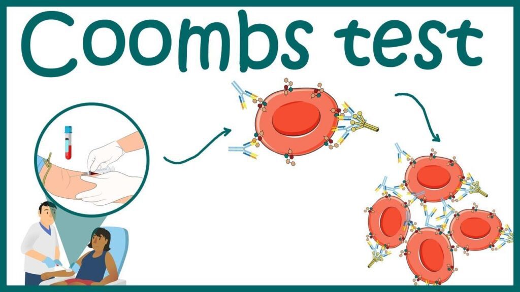 Coomb's Test
