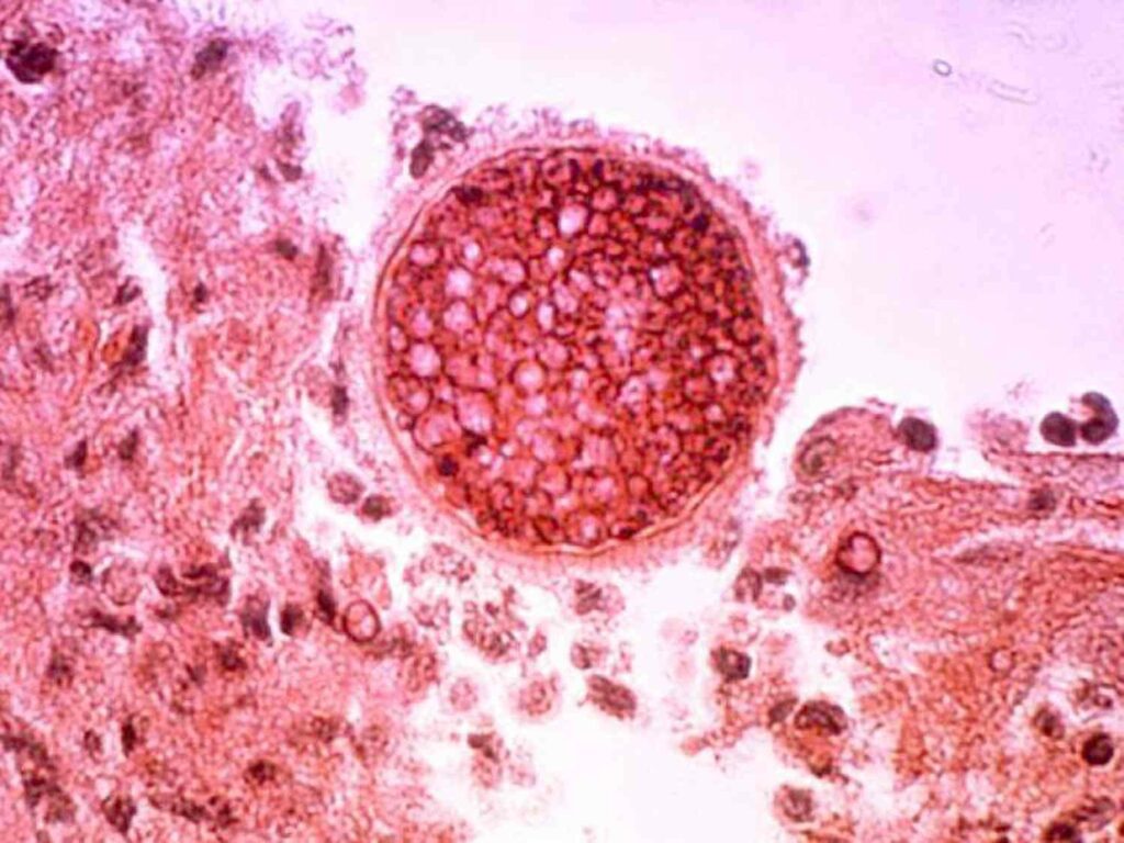 Coccidioidomycosis