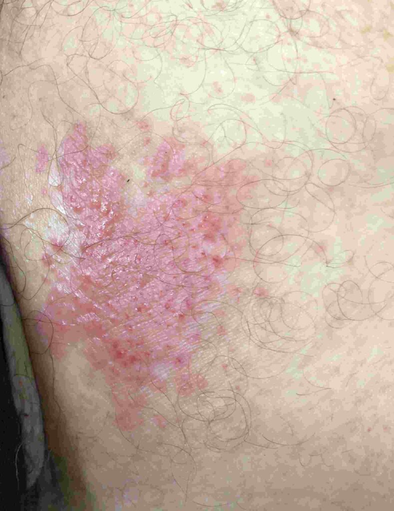 Cutaneous Candidiasis