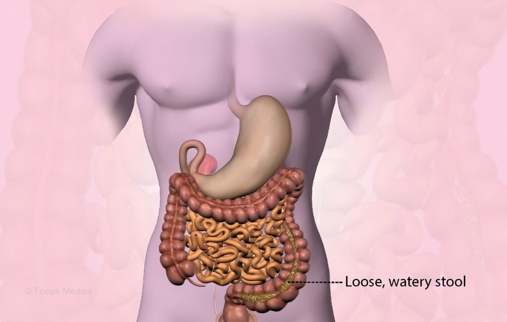 Diarrhea