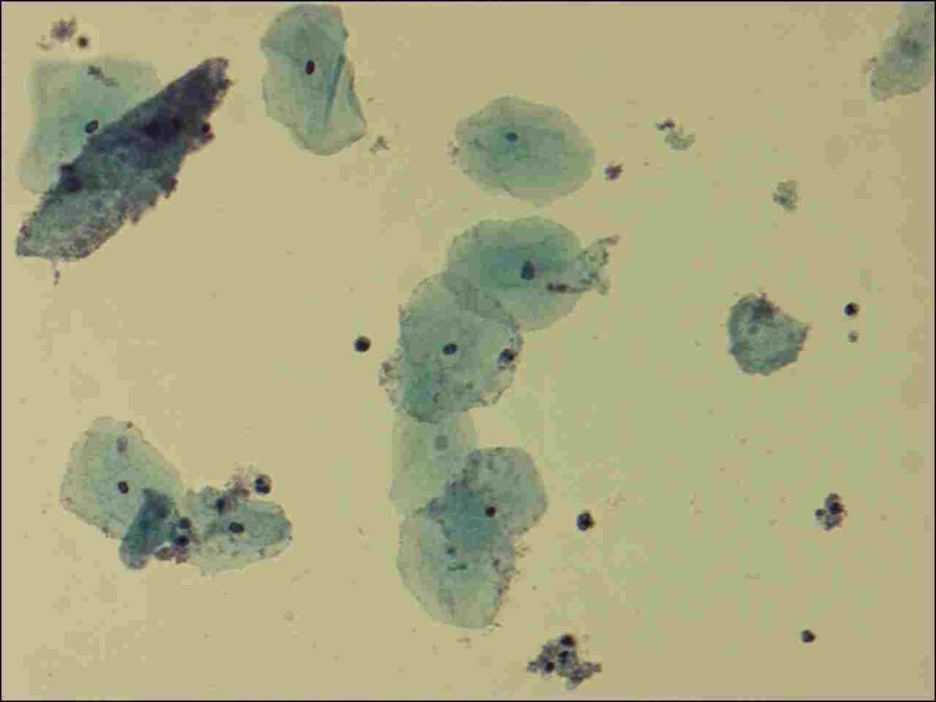Gardnerella vaginalis