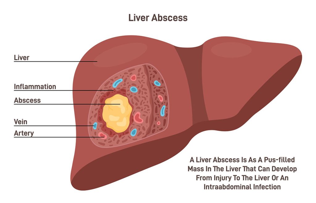Liver Abscess