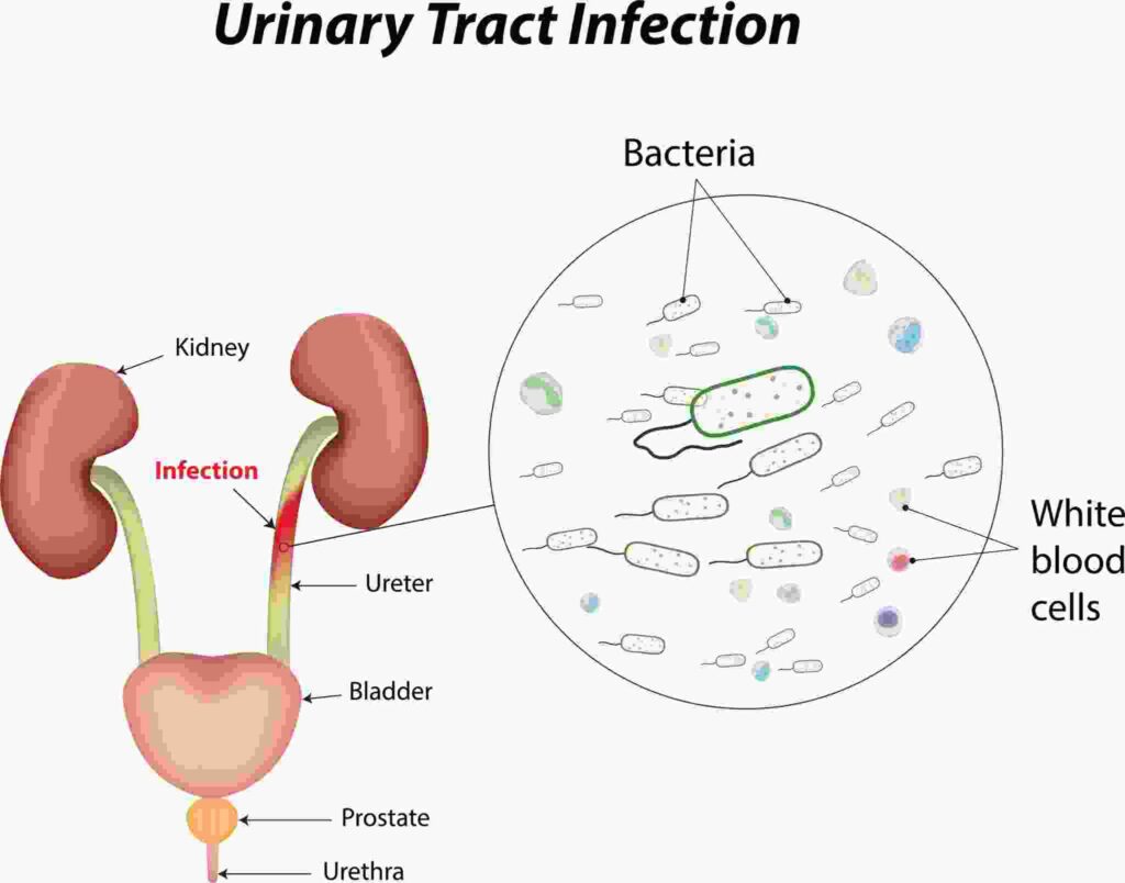 Urinary Tract Infections (UTIs)