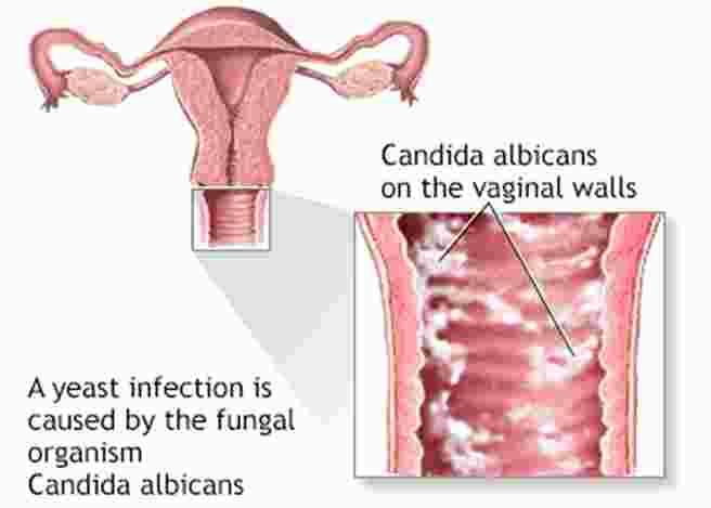 Vulvovaginal Candidiasis