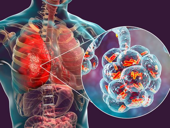 respiratory-tract-infection